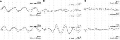 Outcome Prediction by 40-Hz Steady-State Response After Large Hemispheric Infarction